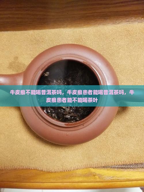 牛皮癣不能喝普洱茶吗