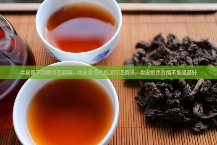 牛皮癣不能喝普洱茶吗